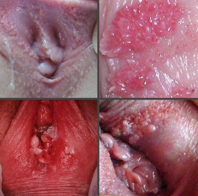 Primo piano di papillomi nella vagina