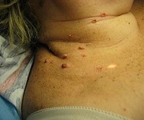 Papillomavirus umano sul collo