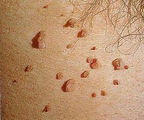Papillomavirus umano sulla pelle