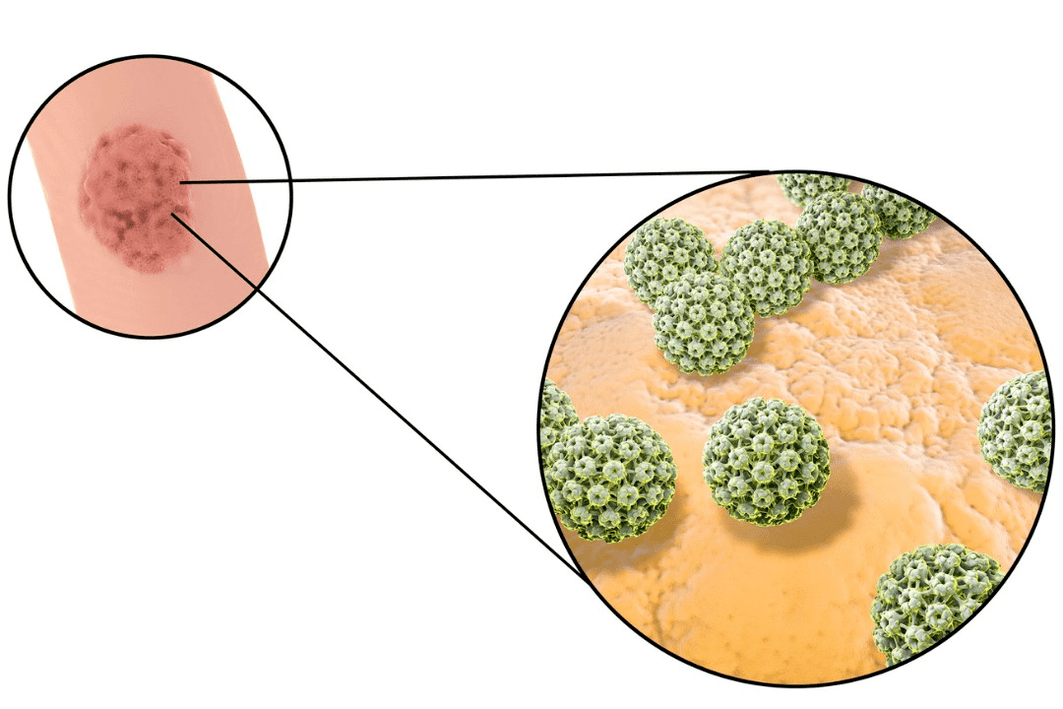 Fonte di infezione da papilloma a cellule squamose
