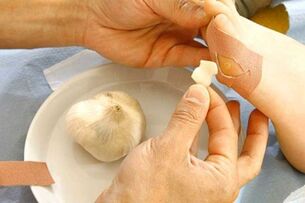 Trattamento dei papillomi con impacco all'aglio